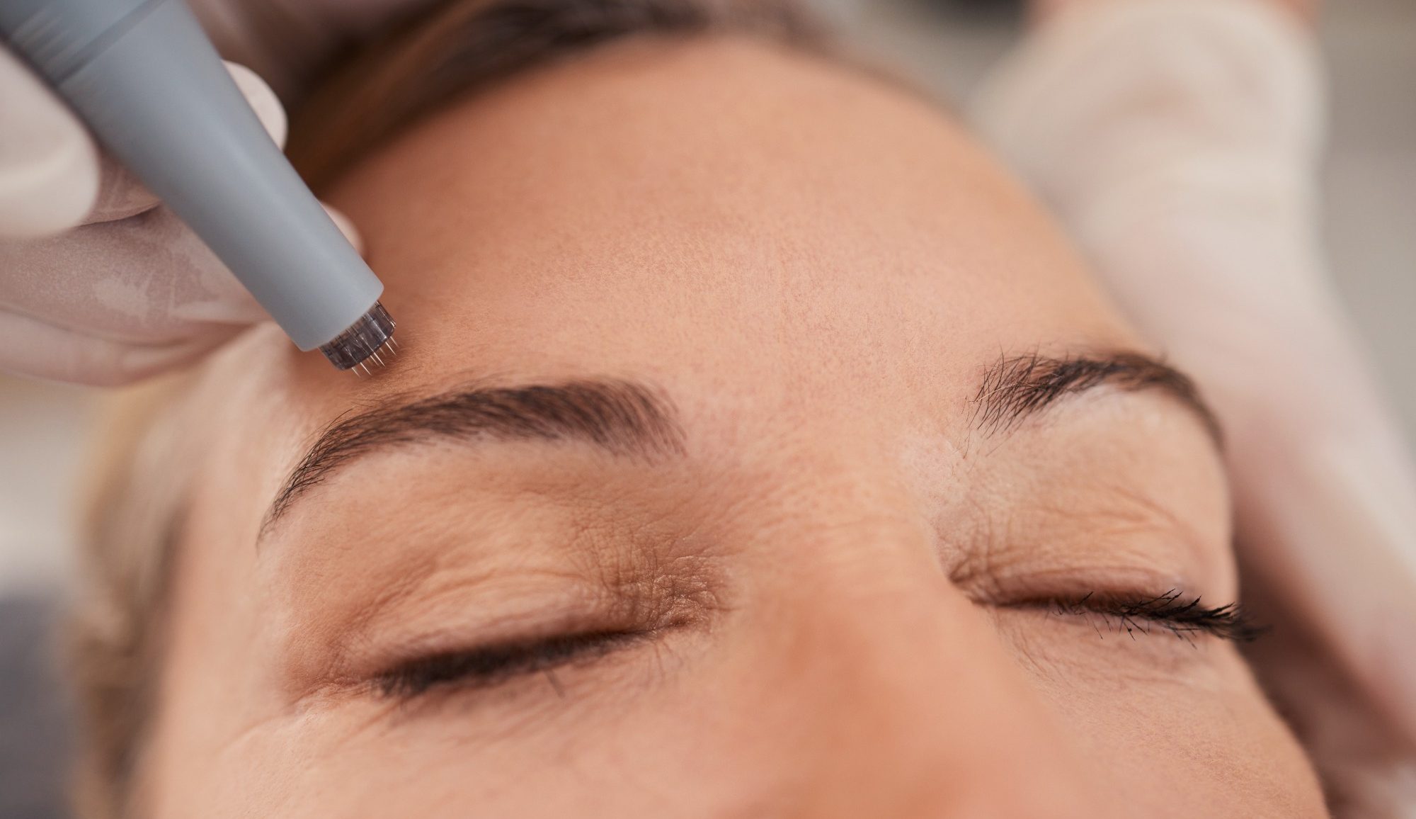 Micro-Needling