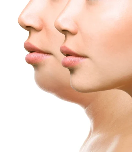 Chin Reshaping, Dermal Fillers, Fat Reduction