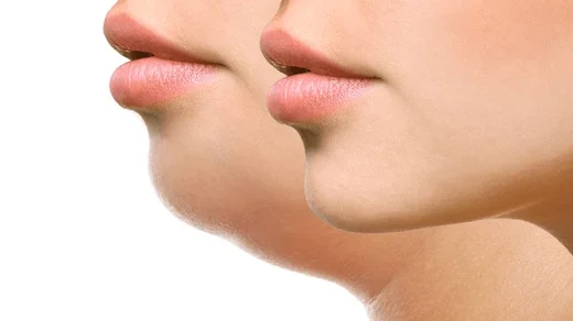 Micro Needling
