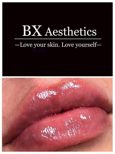 Lip Filler