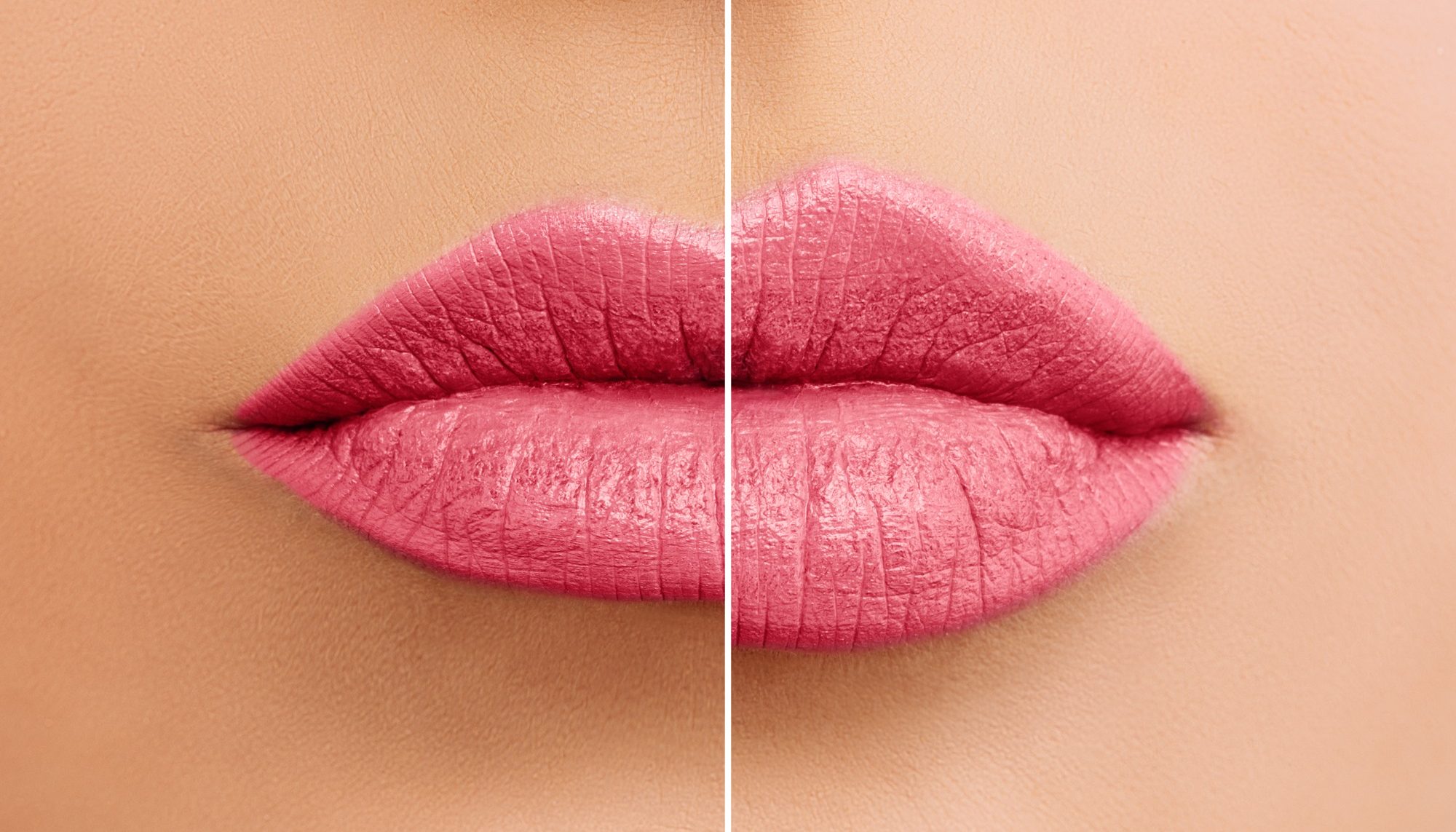 Lip Filler, Nasolabial, Marionette